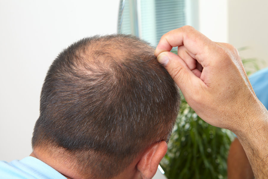 Senior man and hair loss issue